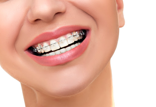 Ortodoncja - Aparaty Ortodontyczne