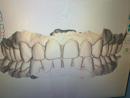Metamorfoza ortodoncja - po1