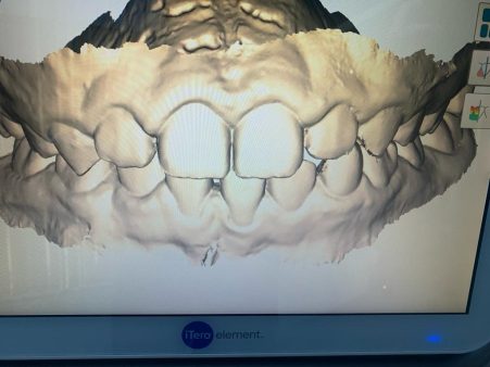 Metamorfoza ortodoncja - po 2