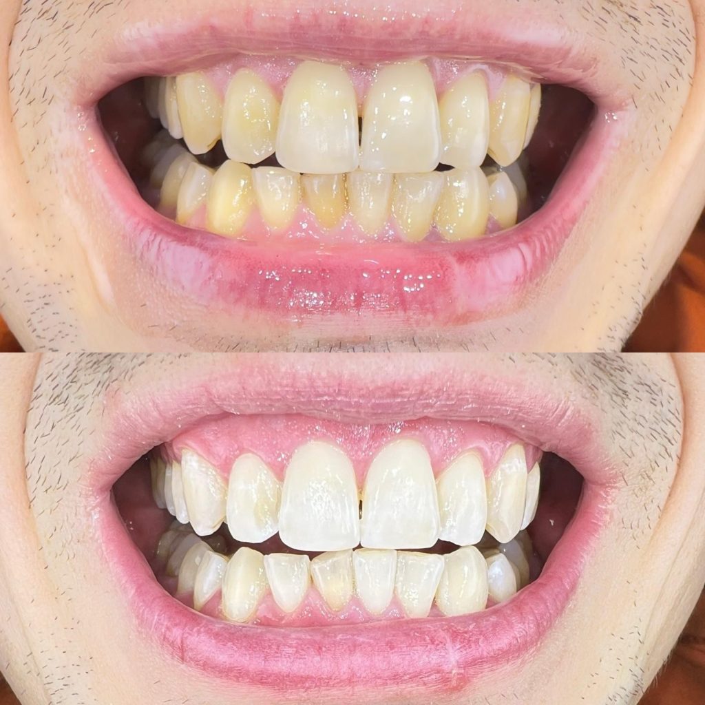 Wybielanie zębów - Defińska Clinic