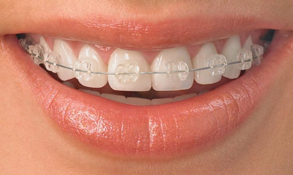 Ortodoncja - Aparaty Ortodontyczne Dentar