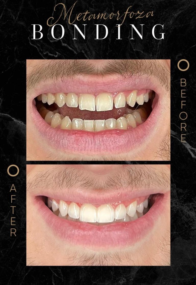 Bonding | Odbudowa zębów - Doktor Defińska Clinic