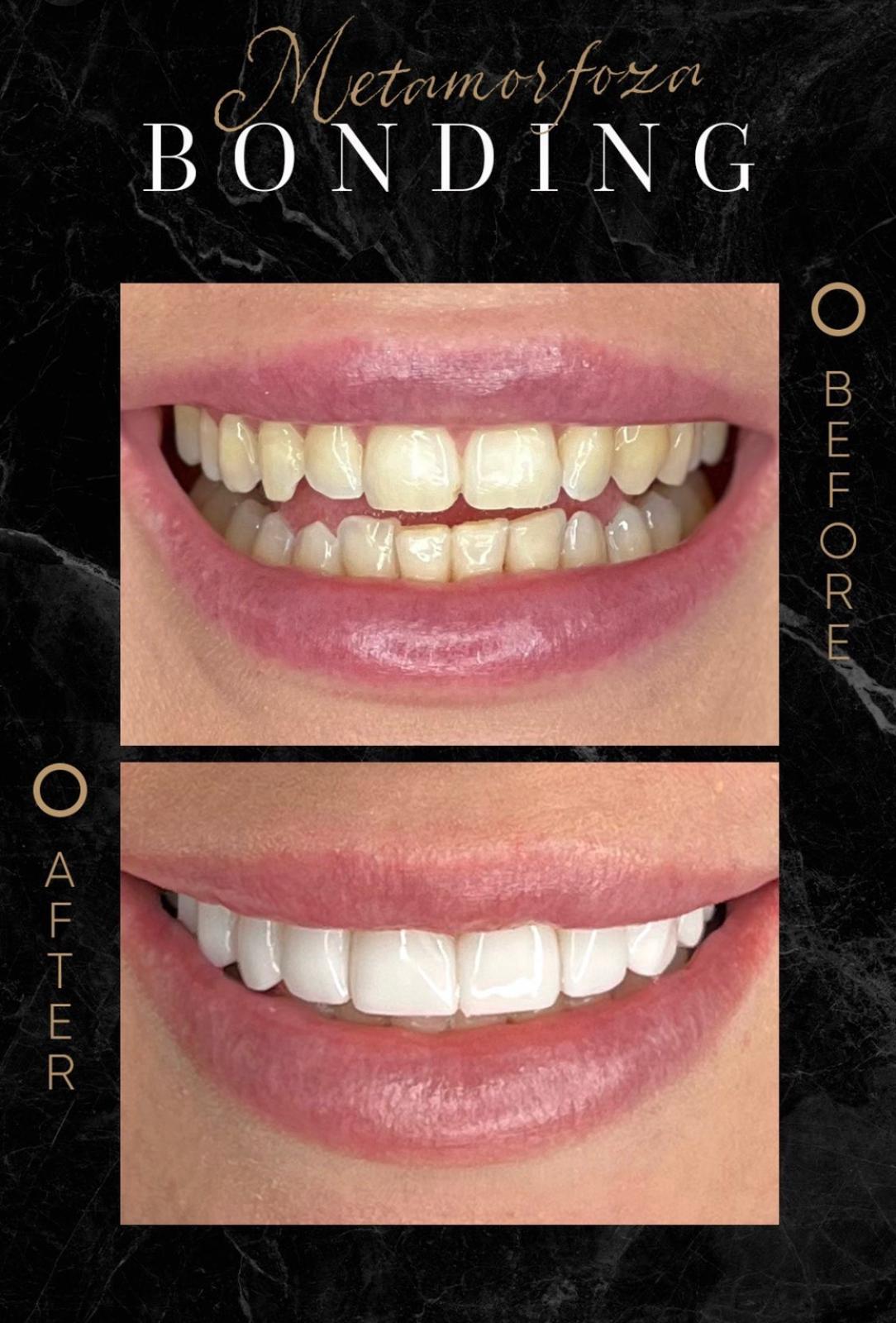 Bonding | Odbudowa zębów - Doktor Defińska Clinic